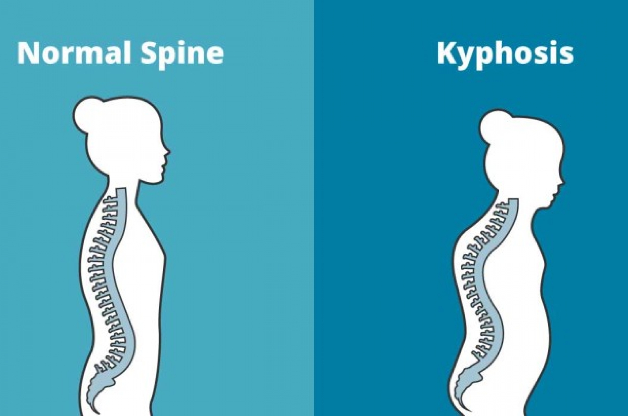 massage-and-kyphosis-humpback-lumina-massage